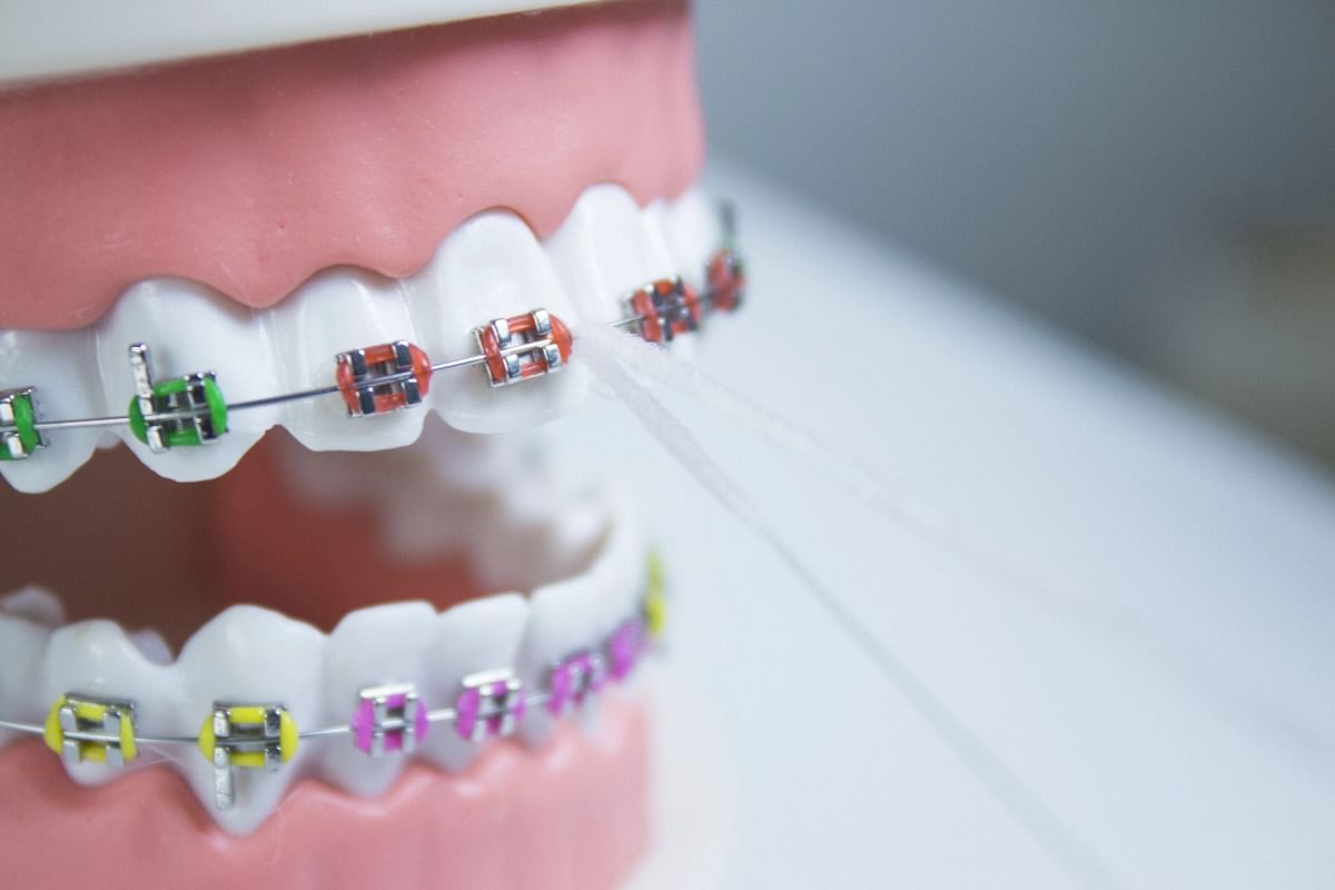Popular Braces Colors in 2025