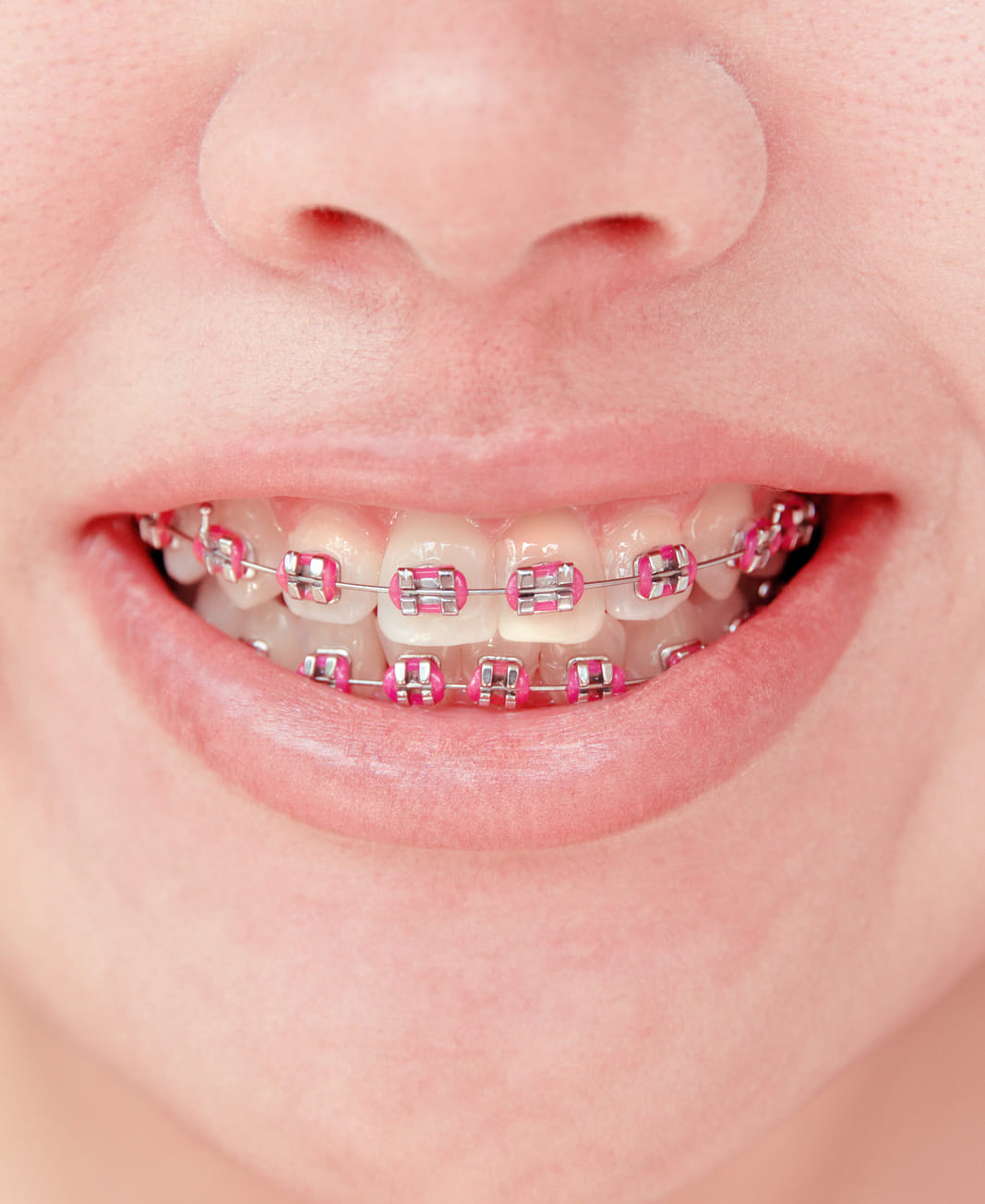 Child smiling with traditional metal braces