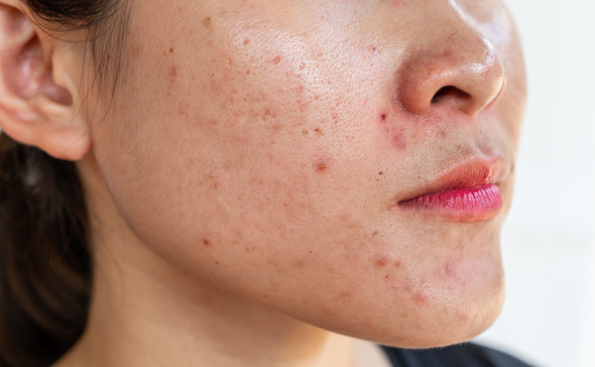 Acne Scars