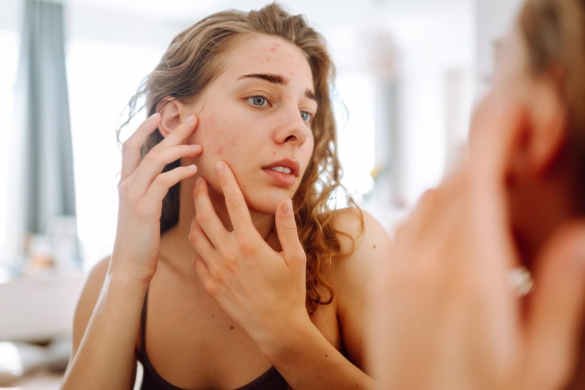 young woman looks at acne on her face in mirror