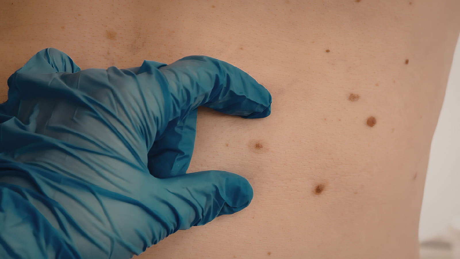 Mohs Surgery Ponchatoula, LA