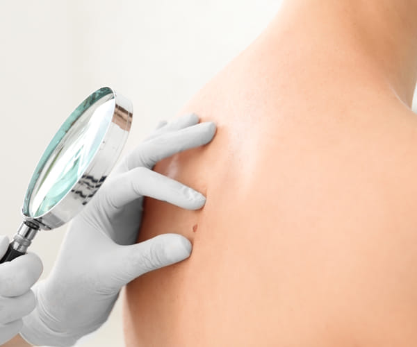 Dermatologist with gloves inspecting mole on patient\'s back