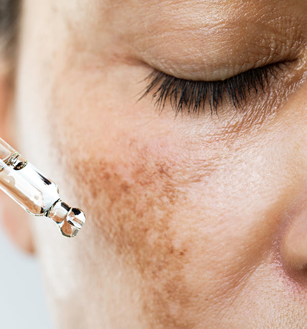 Woman with hyperpigmentation on cheeks using a hydrating serum