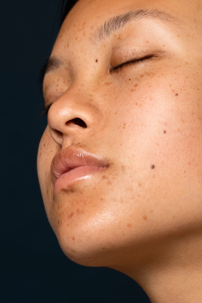 Side view of a woman\'s face with dark spots and hyperpigmentation