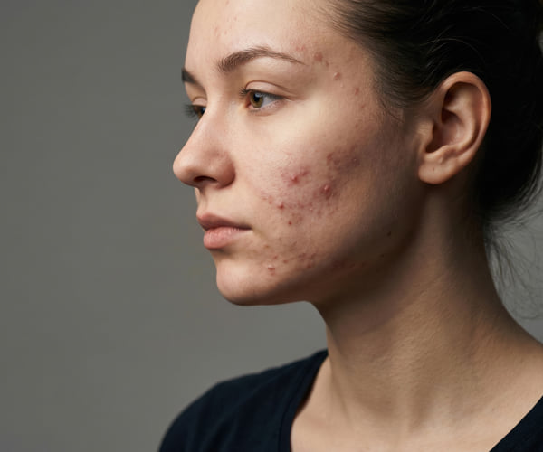Woman with dark hair with her head turned showing off her acne