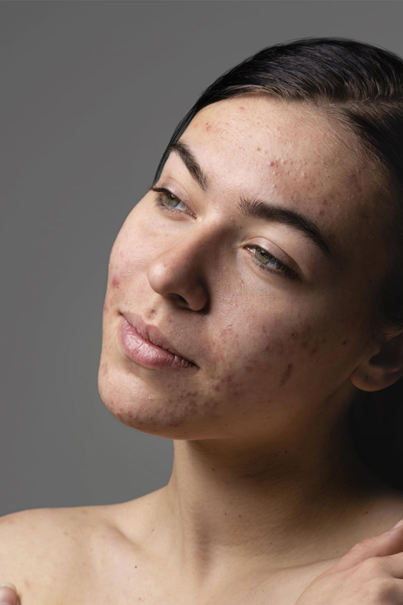 Woman with acne on her face staring off into the distance