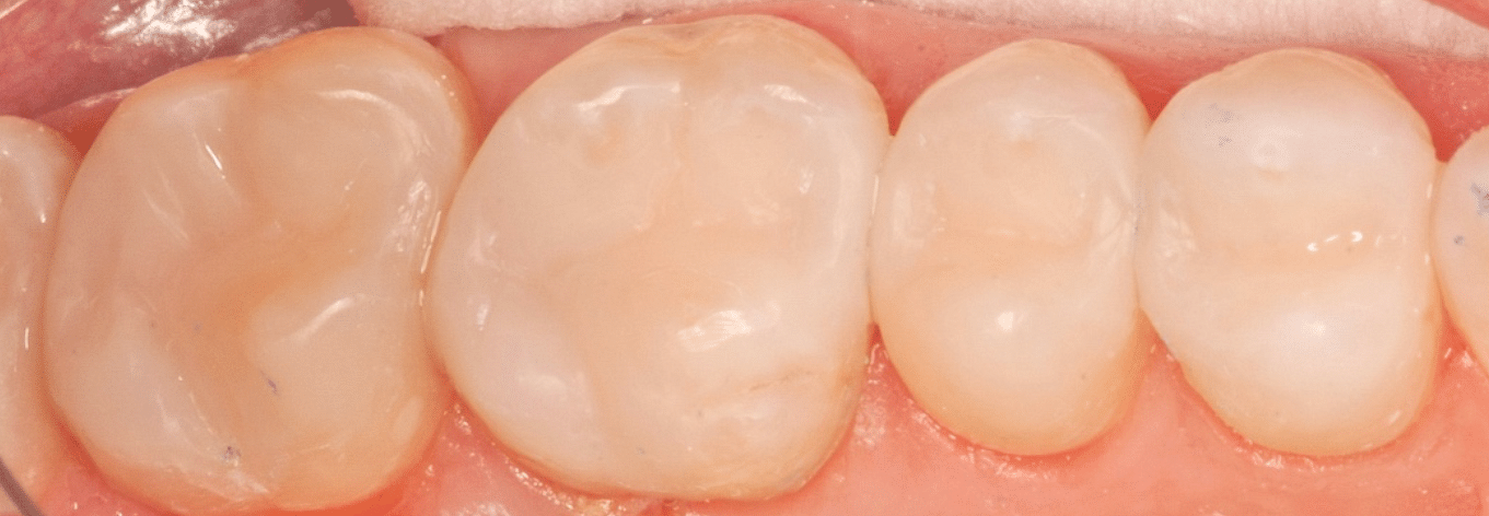 teeth after minimally-invasive dentistry