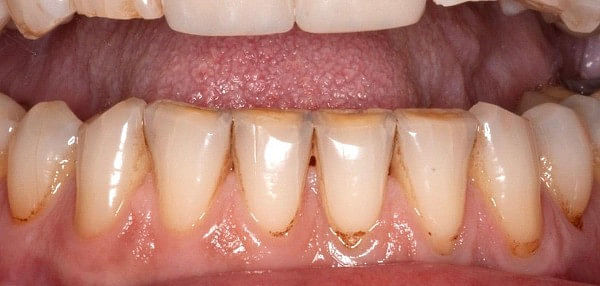 before minimally invasive dentistry