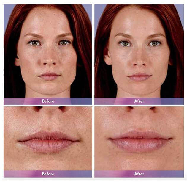 JUVÉDERM Before & After