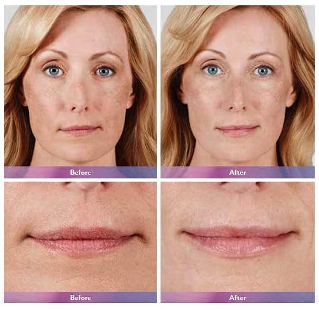 JUVÉDERM Before & After