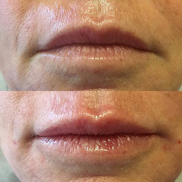 JUVÉDERM Before & After