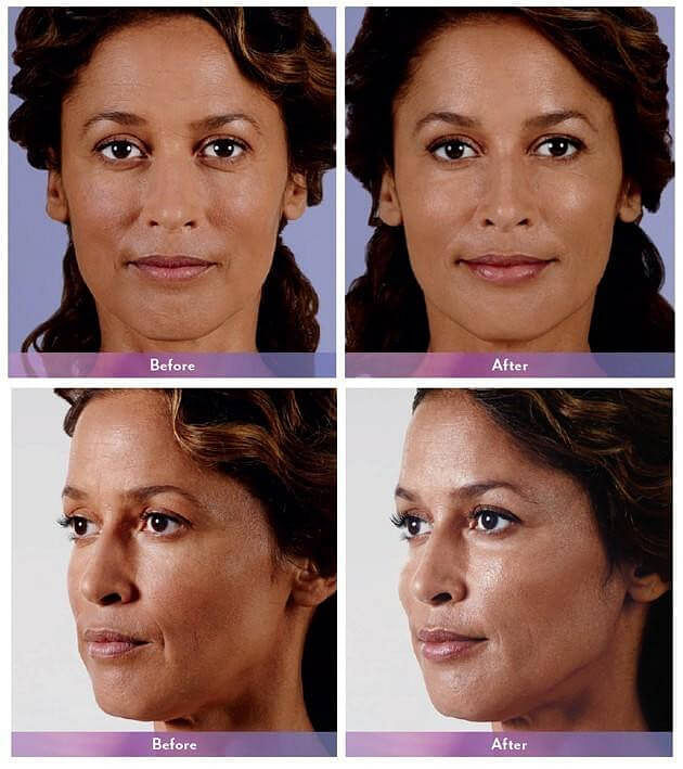 JUVÉDERM Before & After