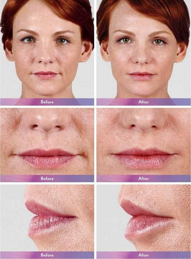 JUVÉDERM Before & After