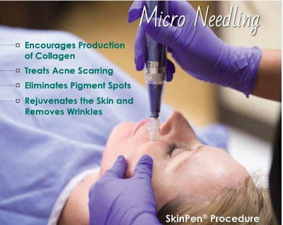 Micro Needling